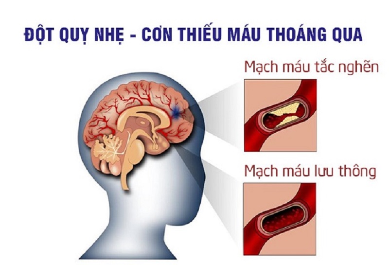 đột quỵ nhẹ